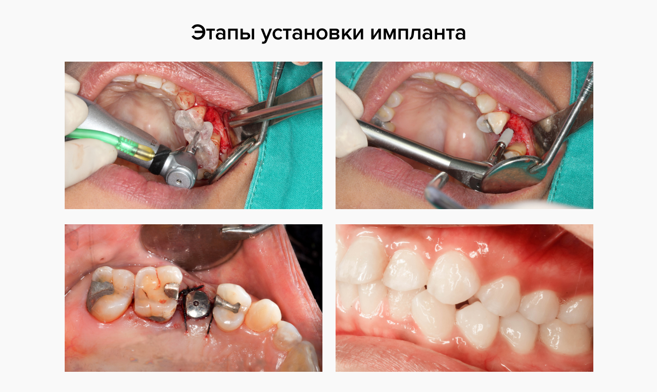 Этапы установки импланта Фото этапов установки импланта зуба